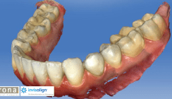 CEREC meets Invisalign®