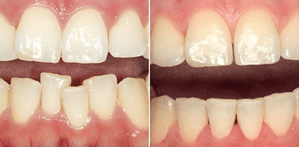 Webinar: Wie erreiche ich ein ansprechendes Lächeln in Rekordzeit?