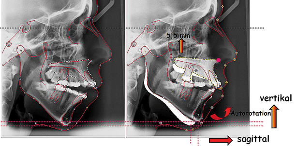 Skelett-Strukturänderungen zur Gesichtsharmonisierung
