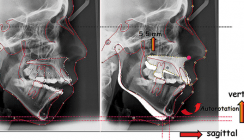 Skelett-Strukturänderungen zur Gesichtsharmonisierung