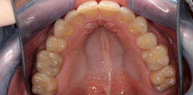 Chirurgie oder dentale Kompensation?