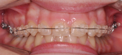 Neue Dimension auf dem Gebiet der SL-Brackets