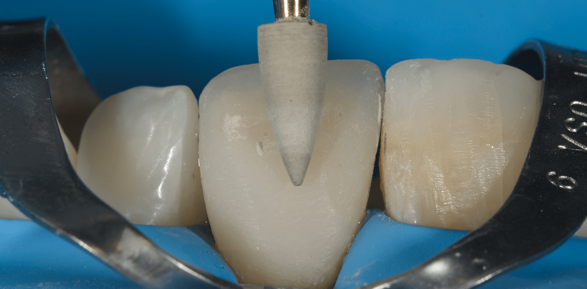 Die smarte Vereinfachung eines Composite-Systems