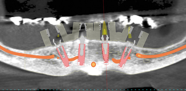 Minimalinvasiv trotz stark reduziertem Knochenangebot