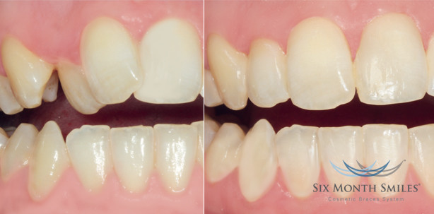 Gerade Zähne in sechs Monaten