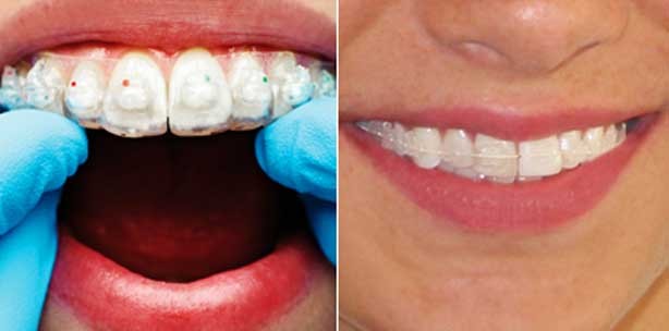 SixMonthSmiles® - Das Erfolgsmodell aus den USA kommt nach Deutschland