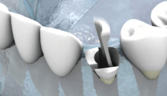 Neue Strategien zum Kieferkammerhalt: Socket Preservation 2.0