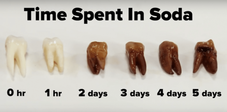 Kohlensäure zersetzt Zahn: So gefährlich können Softdrinks sein