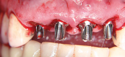 Sofortimplantation mit ­Sofortbelastung in der ästhetischen Zone