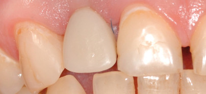 Sofortbelastung in der ästhetischen Zone