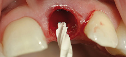 ﻿﻿﻿Sofortimplantation im anterioren Maxillabereich