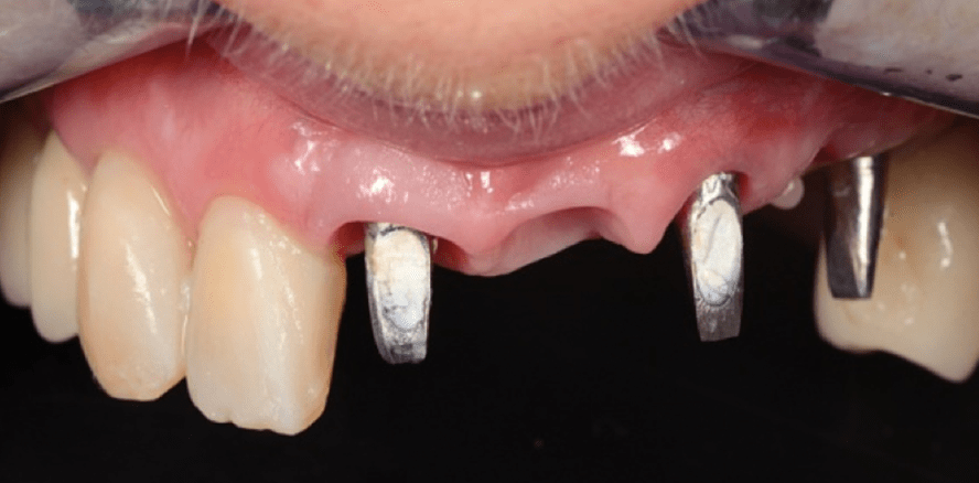 Sofortbelastete Implantatprothetik im ästhetischen Bereich