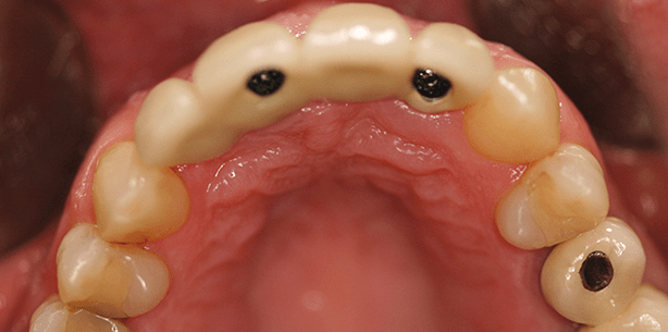 Sofortimplantation und Sofortbelastung in der ästhetischen Zone