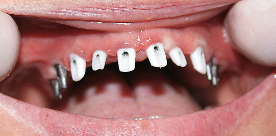 Sofortimplantation mit partieller Sofortbelastung