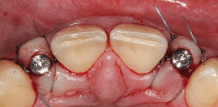 Sofortversorgung durchmesserreduzierter Implantate
