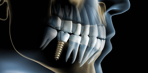 Sofort- & Frühbelastung: das Berner Konzept