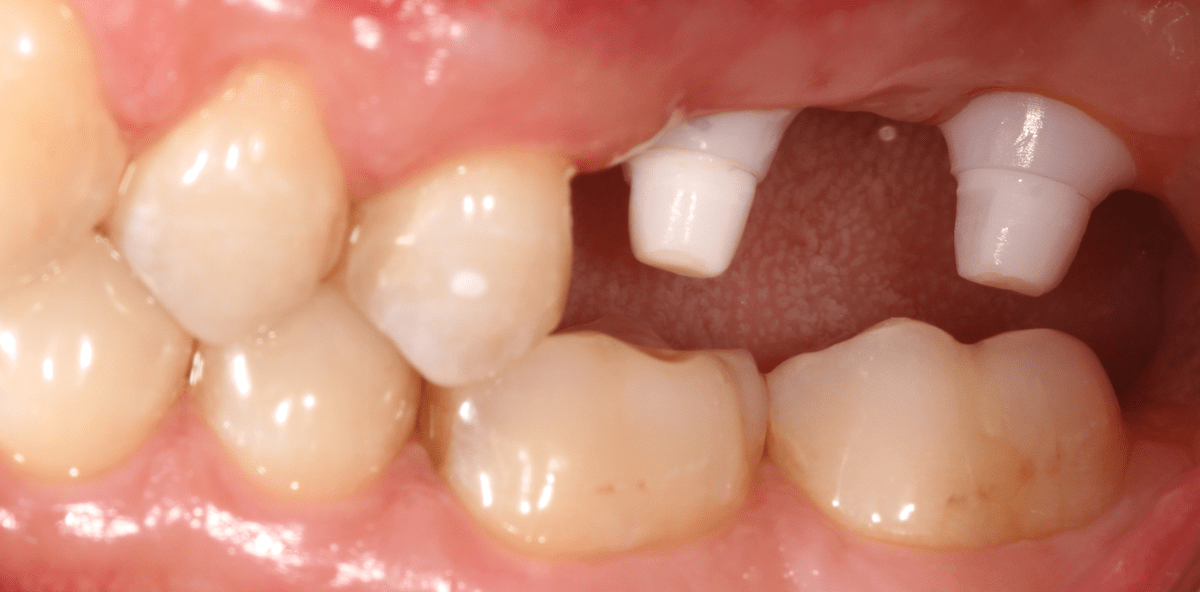 Sofortimplantation mit Keramikimplantaten im Seitenzahngebiet