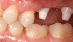 Sofortimplantation mit Keramikimplantaten im Seitenzahngebiet