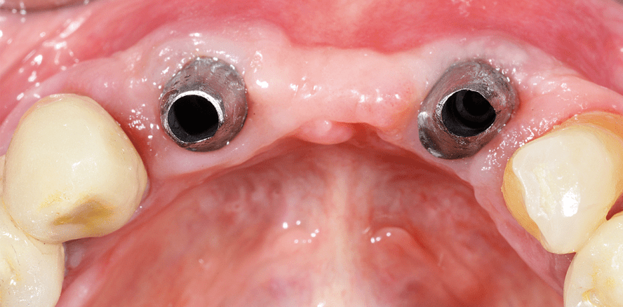 Augmentation in Verbindung mit einer Sofortimplantation
