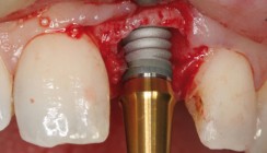 Zahnerhalt oder Extraktion?