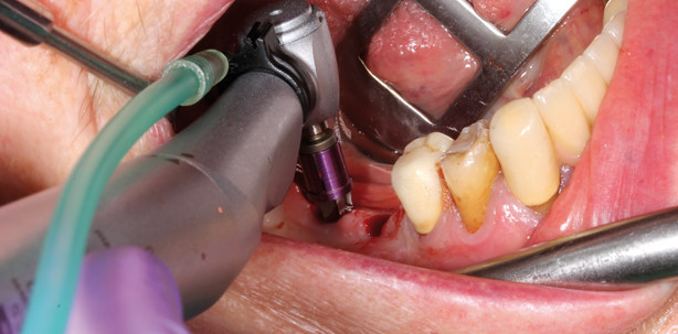 Sofortimplantation nach Implantatbruch im Unterkiefer