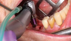 Sofortimplantation nach Implantatbruch im Unterkiefer