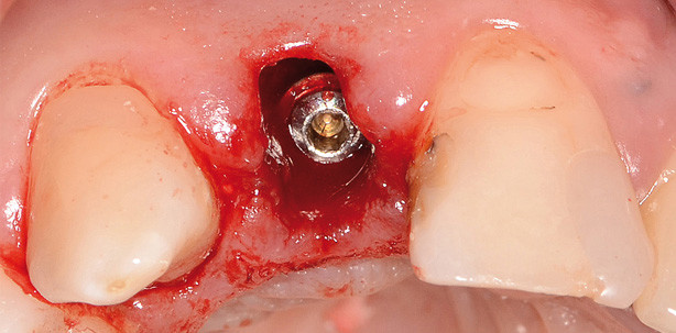 „Prevention for Extension“ in der Implantologie