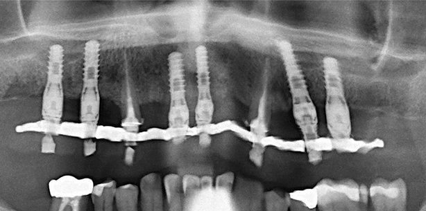 Definitive Sofortversorgung eines ­parodontal kompromittierten Patienten mit sechs Implantaten
