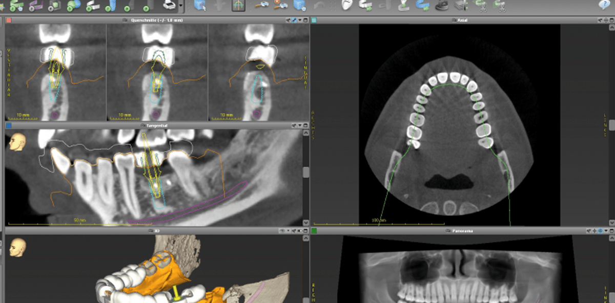 Implantatplanungs- und Prothetiksoftware – ein starkes Team