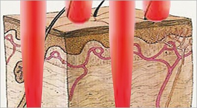 Fraktionierte CO2-Lasertherapie bei lichtgeschädigter Haut