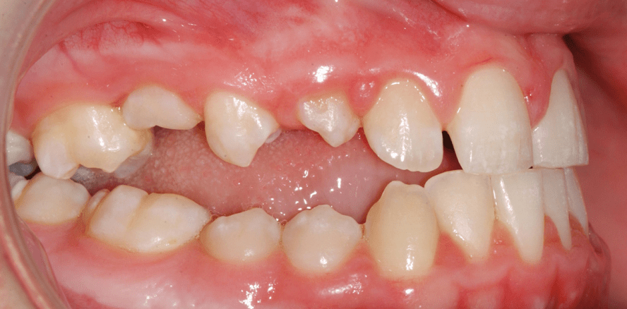 Ätiologie und Behandlung von posterior offenen Bissen