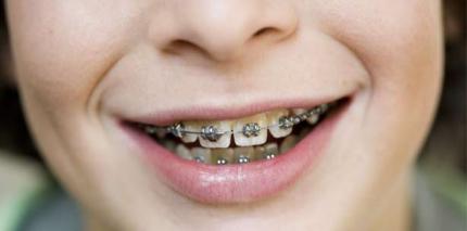 Glattflachenversiegelung Bkk Vbu Zahlt Zuschuss Zwp Online Das Nachrichtenportal Fur Die Dentalbranche