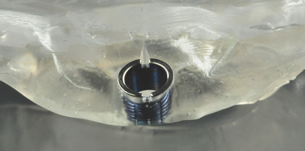 Weichgewebsmanagement mittels ­schablonengeführter Navigation