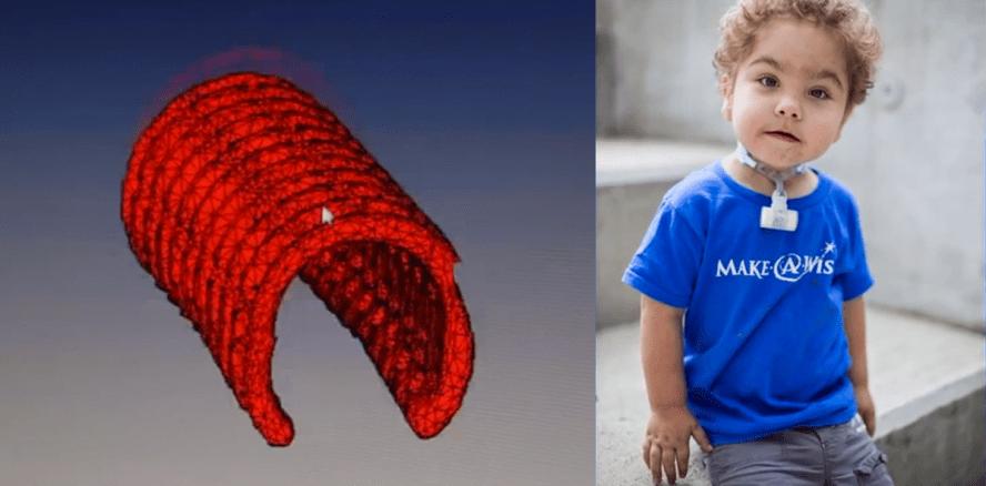 Atemwegsgerüst aus 3-D-Drucker rettet Kindern das Leben