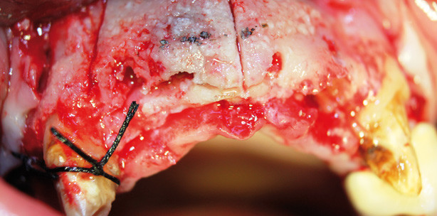 Bone Splitting und Spreading als ­minimalinvasives Verfahren