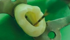 Schallbasierte Spülung im Wurzelkanal