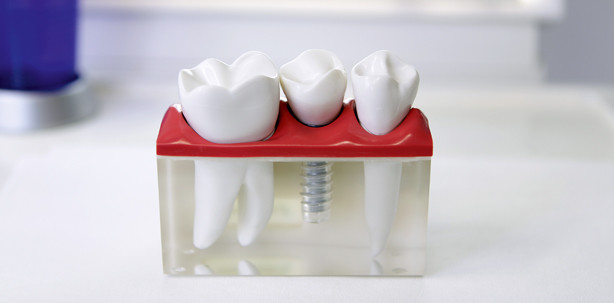 Implantate: Innovation aus der Praxis für unsere Patienten