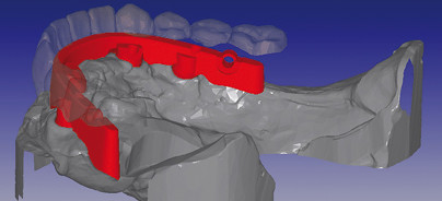 CAD/CAM-gefertigte implantatgetragene Stege