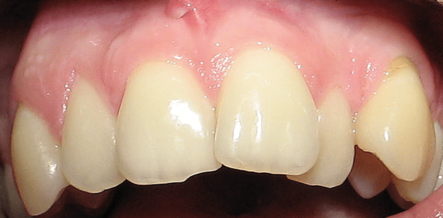 Sofortimplantation und aktive Weichgewebsmanipulation bei ­okklusalem Trauma