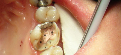 Das Geheimnis des Stopfens