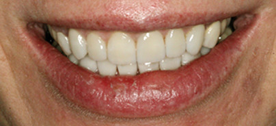 Zähne "like Hollywood"