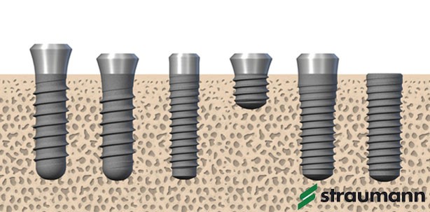Roxolid – ein Implantatmaterial erobert den Markt