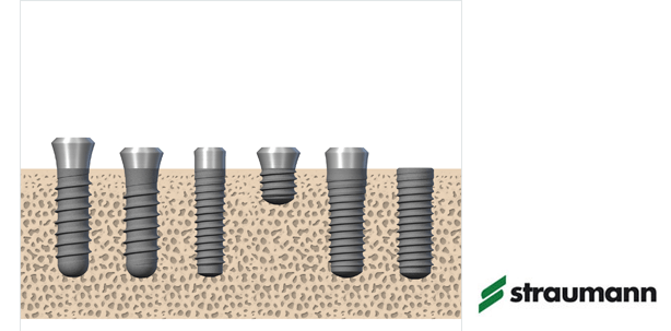 Straumann führt Lifetime Plus Garantie für Roxolid-Implantate ein