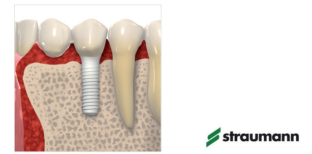 Patienten präferieren Keramikimplantate