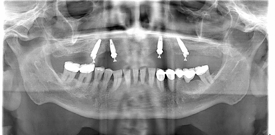 Full-Arch-Sofortversorgung im Oberkiefer auf vier Implantaten