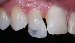 Maximaler Zahnerhalt und Ästhetik mit Minimal-Prep-Teilveneer