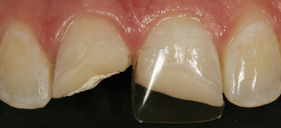 Wiederauferstehung der Frasaco Stripkrone