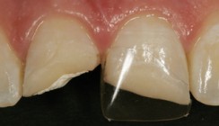 Wiederauferstehung der Frasaco Stripkrone