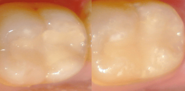 2-Jahres-Studie: glasionomer-basiertes Restaurationssystem