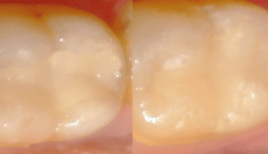 2-Jahres-Studie: glasionomer-basiertes Restaurationssystem